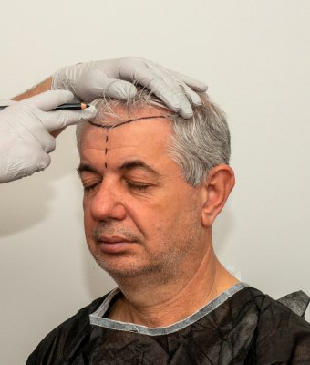 All-inclusive hair transplant package overview at a top Istanbul clinic, featuring transparent pricing, VIP airport transfer, hotel accommodation, and surgeon-led procedure.