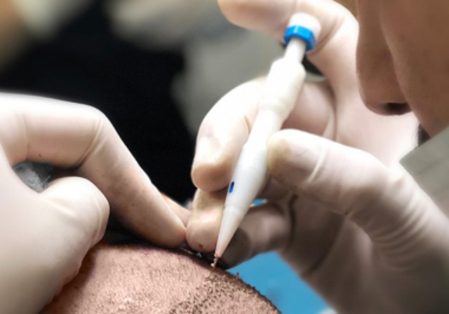 Consultation photo showing a surgeon analyzing different hair types - straight, curly, and fine - to determine candidacy for the DHI Choi Pen hair transplant technique.