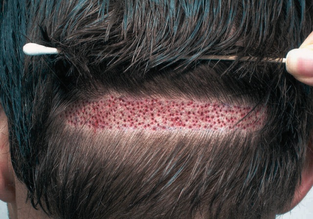 Split-screen visual comparison: Left side shows a No-Shave DHI procedure with long hair; Right side shows a Standard DHI procedure on a closely shaved scalp.