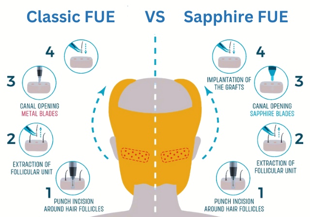 Everything You Need to Know About Sapphire FUE Hair Transplantation