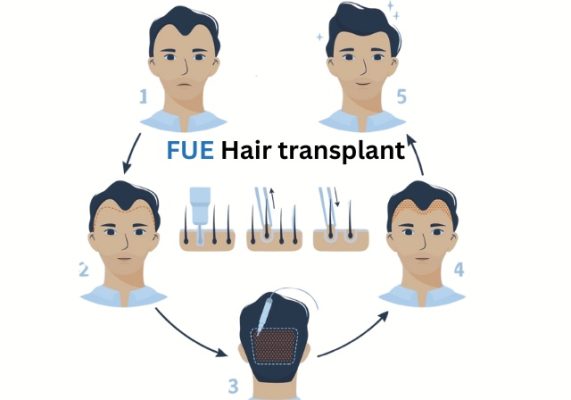 High-resolution before and after photos of a patient showing natural hairline and density results from an FUE (Follicular Unit Extraction) hair transplant procedure.