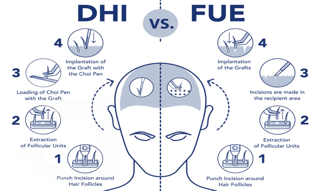 Split-screen comparison infographic: FUE vs DHI hair transplant techniques performed in Turkey, showing tool differences, procedure steps, and typical results side-by-side.