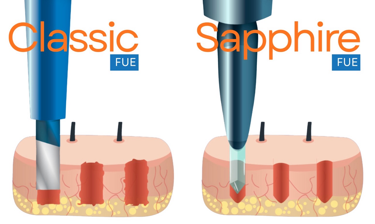 Close-up comparison visual: Standard metal punch vs. Sapphire blade tip used in FUE hair transplant procedures, highlighting the difference in sharpness and channel creation.