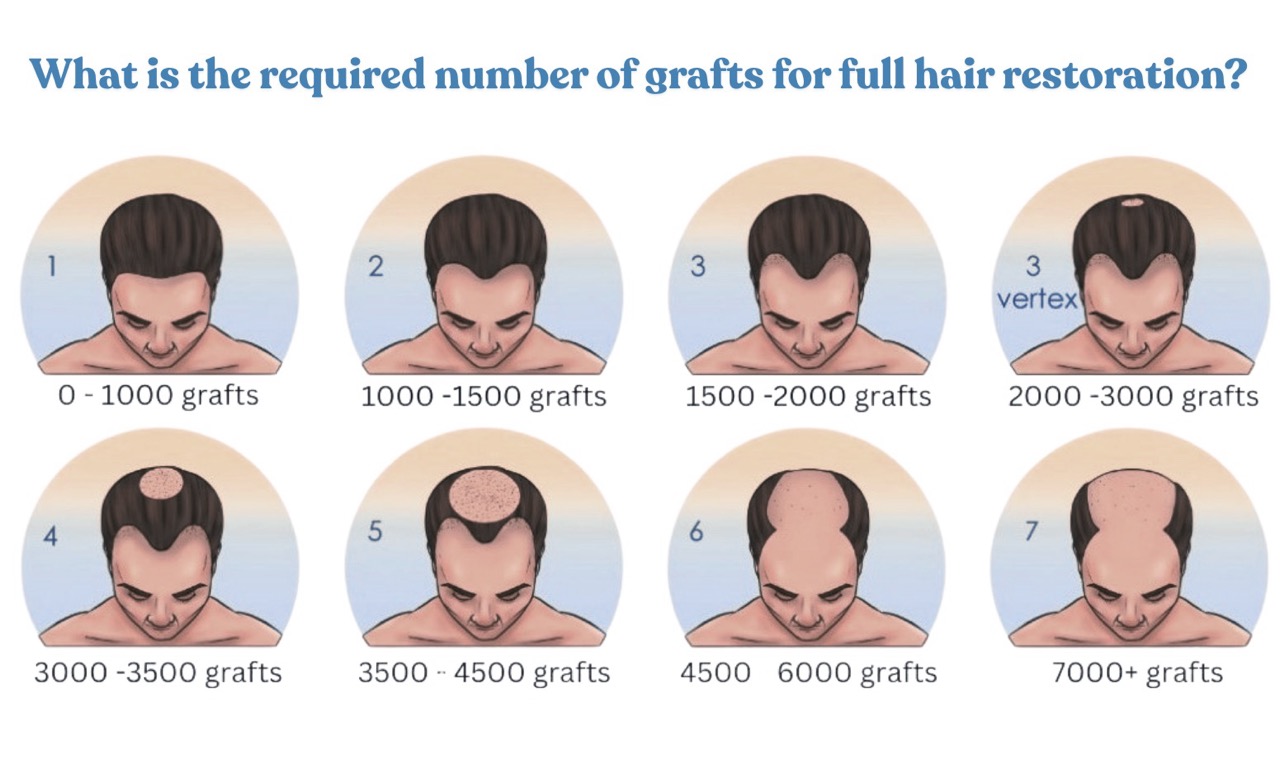 Visual graft estimation guide for a natural hairline transplant, showing a diagram of the frontal hairline zone with graft density zones (higher density at front, softer at temples).