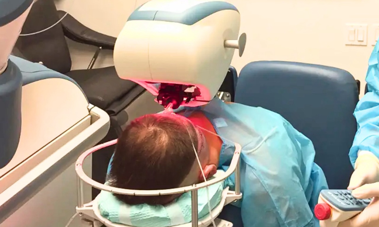 State-of-the-art robotic hair transplant system (like ARTAS) in operation, using AI and precision robotics to assist a surgeon during follicular unit extraction (FUE).