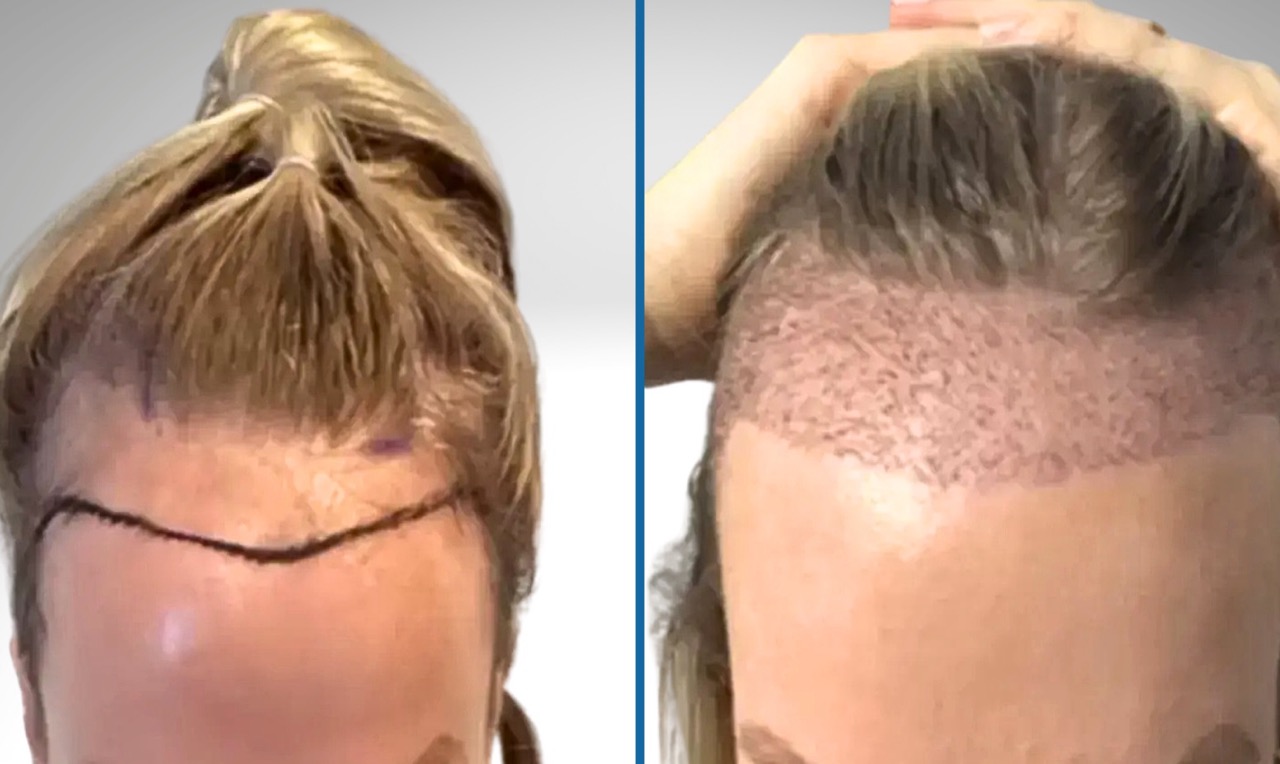 A female patient consulting with a hair transplant specialist about advanced FUE and DHI techniques for treating female pattern hair loss, with a focus on natural hairline design.