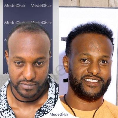 DHI hair transplant before after on Afro-textured hair showing excellent curly hair results.
