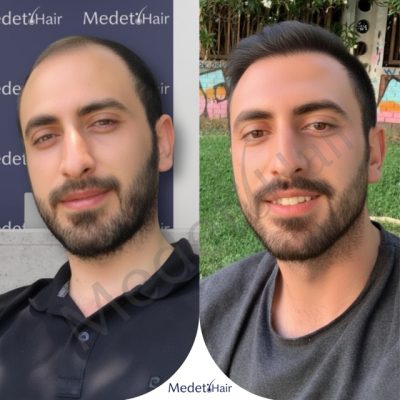 Eyebrow hair transplant using DHI technique before after results.