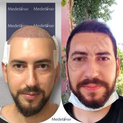 Age-appropriate natural hairline design with DHI for mature man before after.