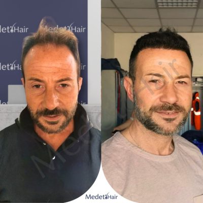 DHI hair transplant combined with PRP therapy for enhanced growth before after.