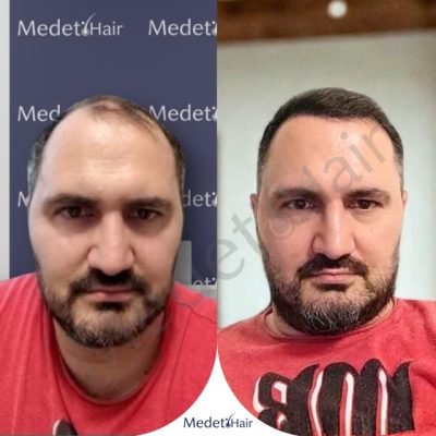 Repairing old FUE dot scars with new DHI hair transplant over them.