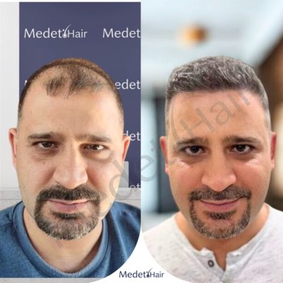 DHI transplant results on thick, coarse Asian hair type before after.