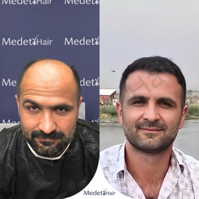 Lowering a high hairline with dense DHI hair transplant before after photos.