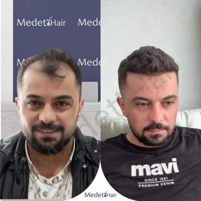 Before after DHI transplant for diffuse mid-scalp thinning in men.