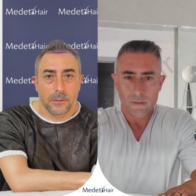 Body hair transplant (BHT) from beard to scalp using DHI method before after results.