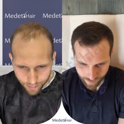Young man hairline design and dense packing DHI transplant before after photos.