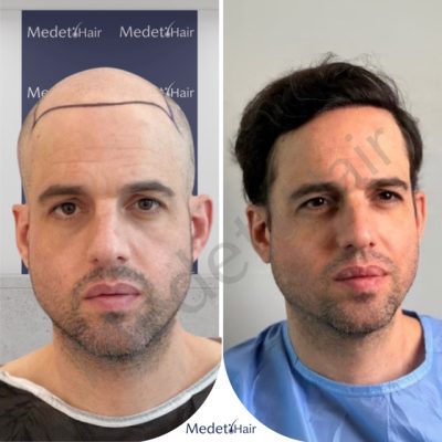 Most dramatic DHI hair transplant transformation before after - ultimate density result.