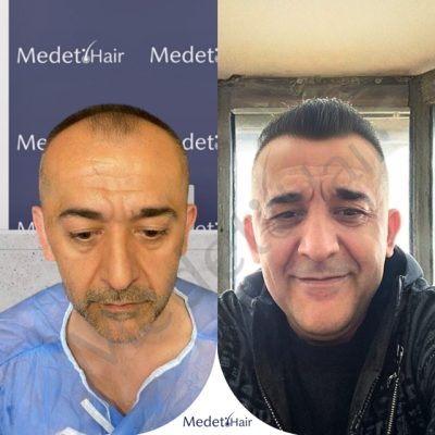 Norwood 3 to full density hair transformation with DHI hair transplant before after.