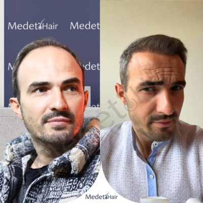 Before after photos of temple point restoration using DHI hair transplant technique.