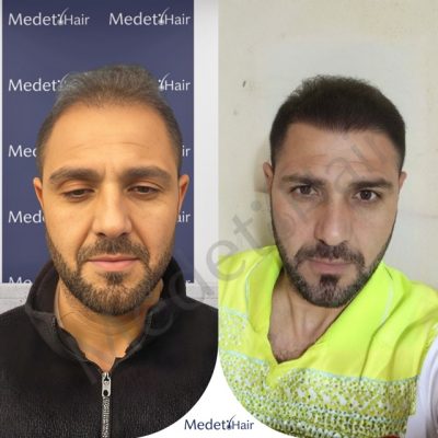 DHI hair transplant results for severe crown balding before and after, demonstrating excellent coverage.