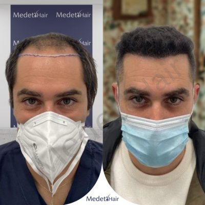 Covering round alopecia areata bald spots with DHI hair transplant.