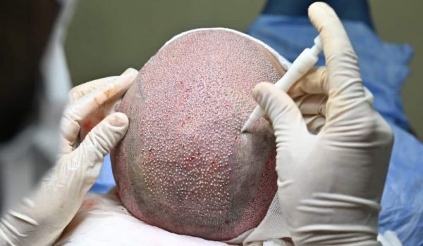 DHI Hair Transplantation in Turkey (Direct Hair Implantation)