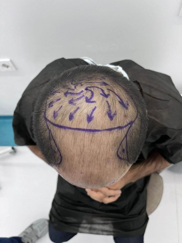 Turkish hair transplantation cost